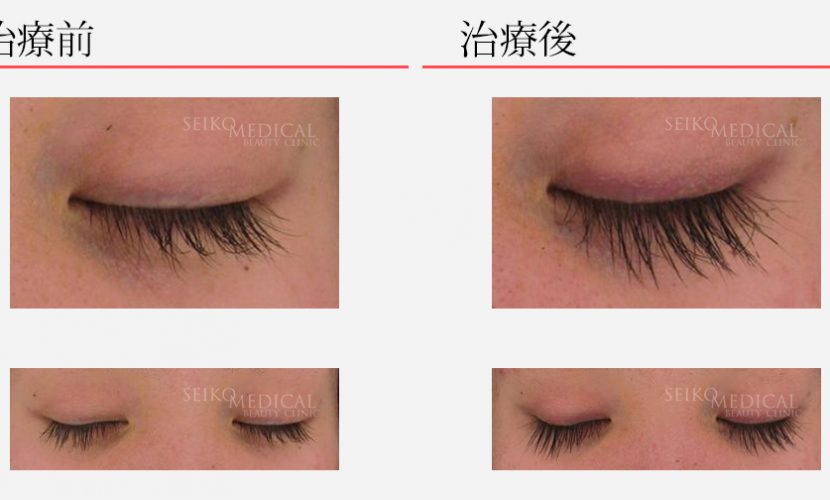 まつ毛美容液 グラッシュビスタのご紹介 | ニキビ治療の実績多数