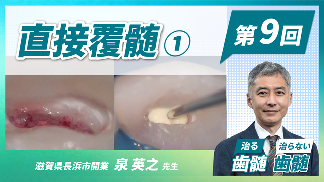 治る歯髄 治らない歯髄 - 歯髄保存の科学と臨床 - 第8回 「間接覆髄