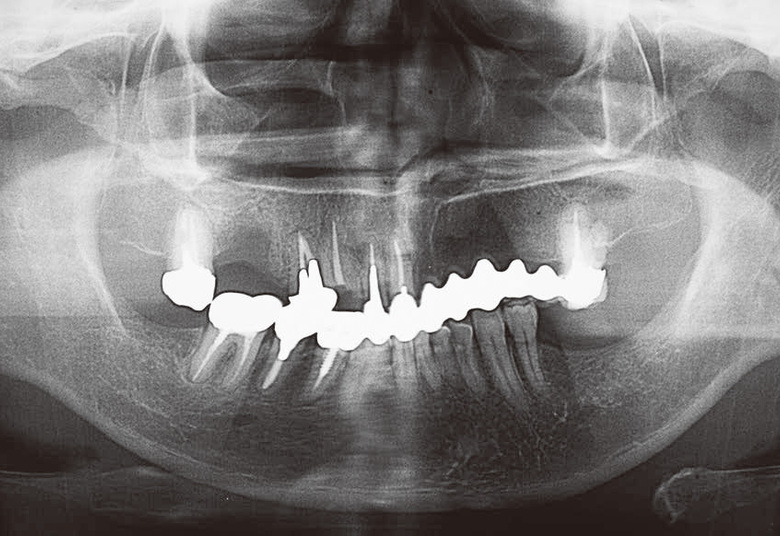 咬合平面の不正により審美，咀嚼障害を 呈した症例における咬合再構成