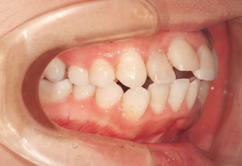 矯正治療後に前歯部審美修復を 行った症例 | Doctorbook academy