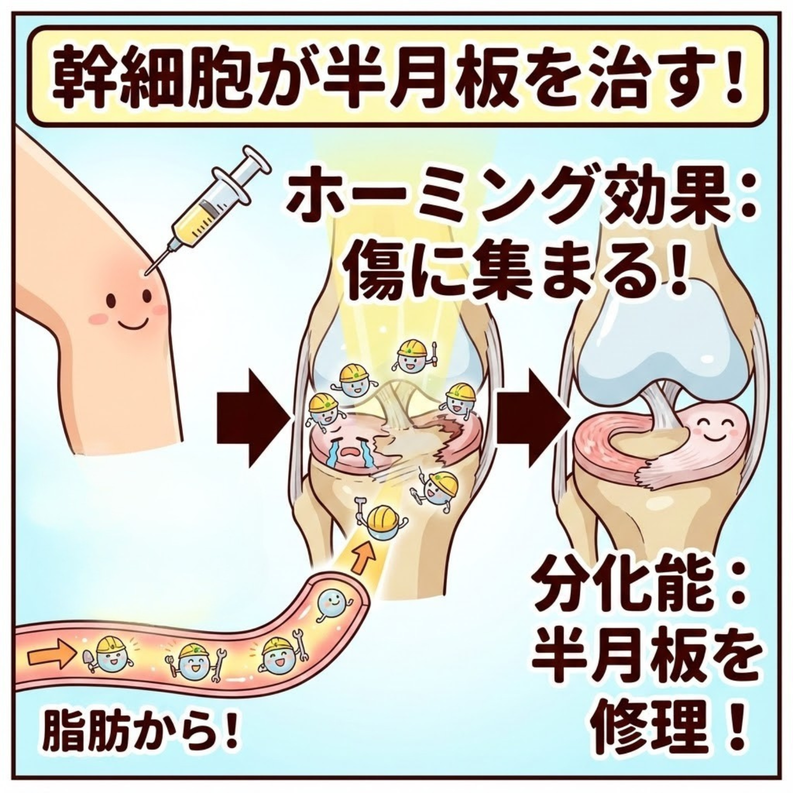半月板損傷・断裂に特化した再生医療（幹細胞治療）：手術で「切り取ら