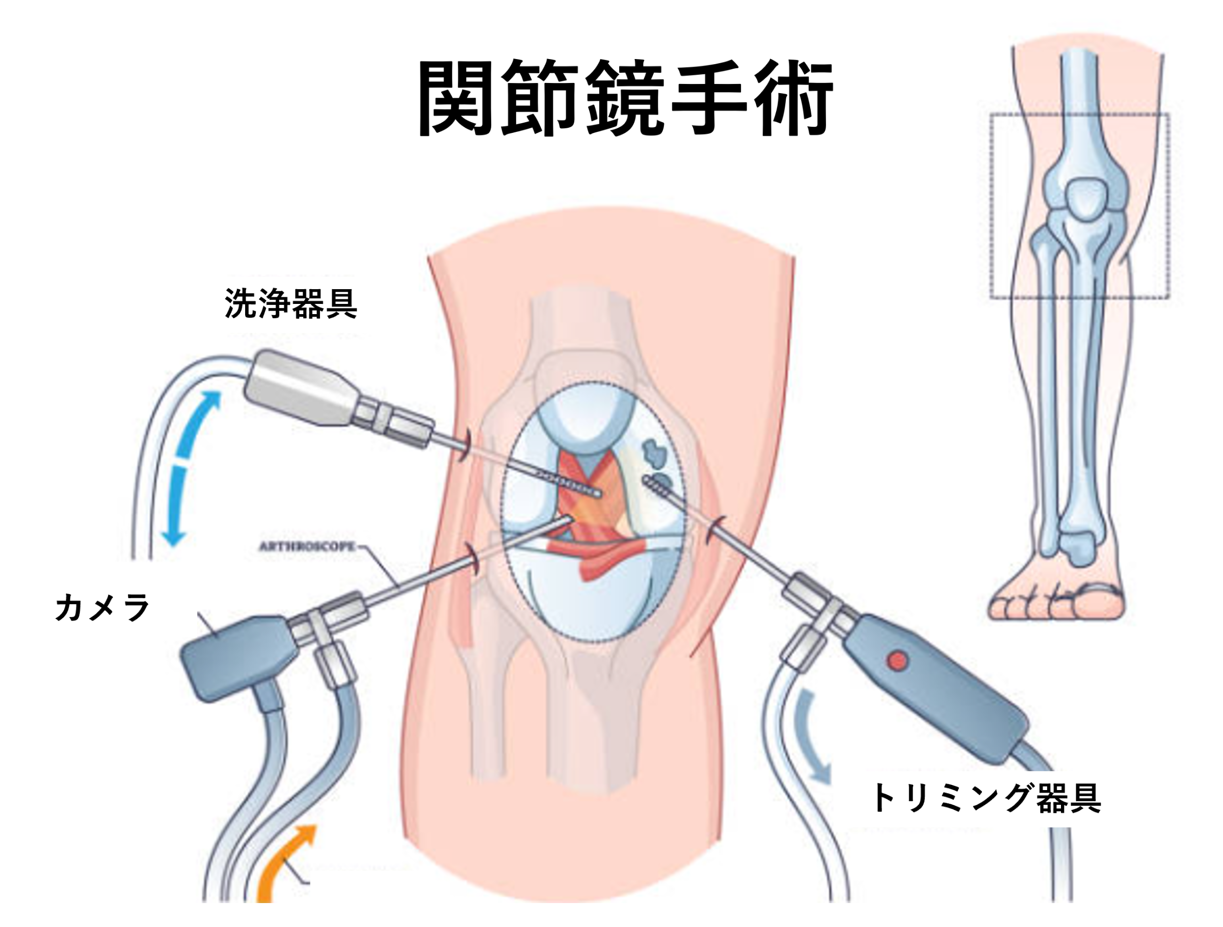 変形性膝関節症の手術とは？手術のタイミングから入院まで医師が解説！