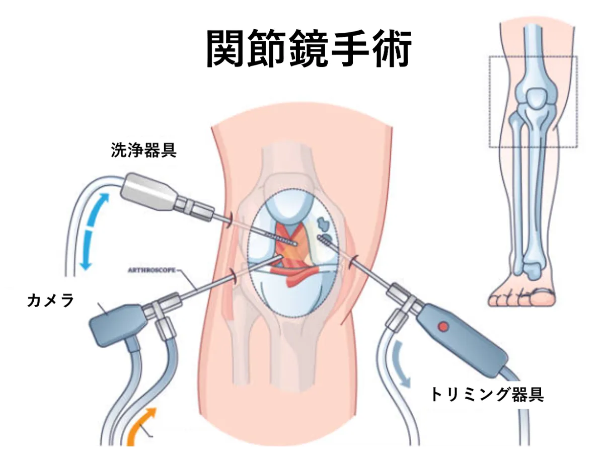 変形性膝関節症の手術とは？手術のタイミングから入院まで医師が解説！