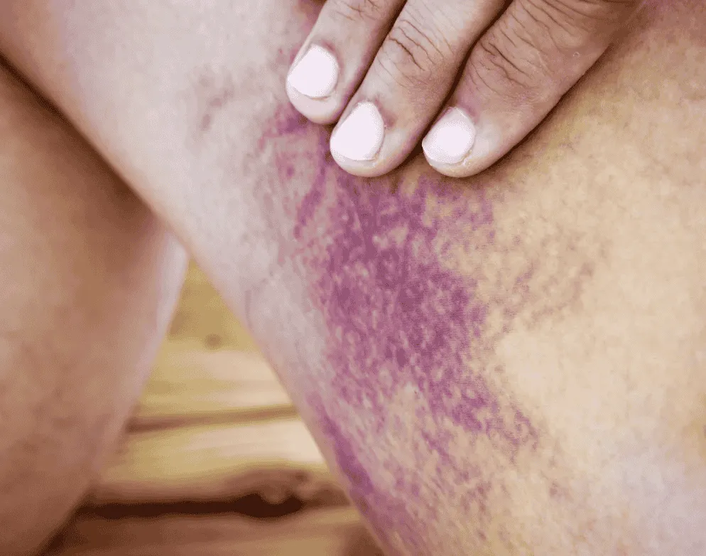 放置は危険？皮膚に紫斑が出る血管炎を専門医が早期発見【自由が丘】