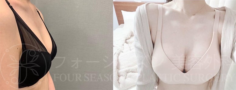 韓国整形/韓国美容外科】「大公開」ベラジェル豊胸手術♥BEFORE➔AFTER