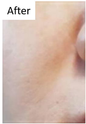 塗るボツリヌストキシンでしわが消える…？ | 美容皮膚科・Dr.MISAKOの