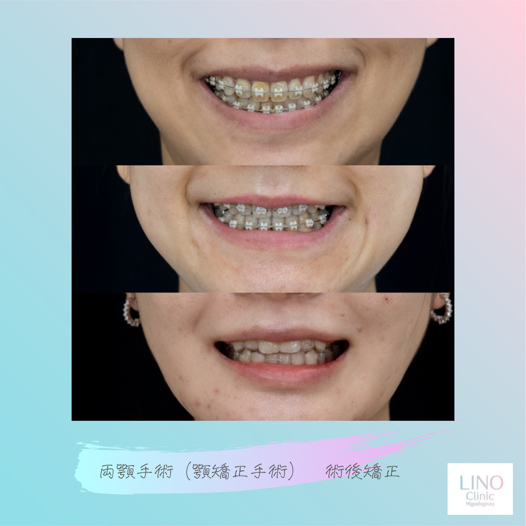 顎矯正手術（両顎手術）における術前矯正と術後矯正について | リノ