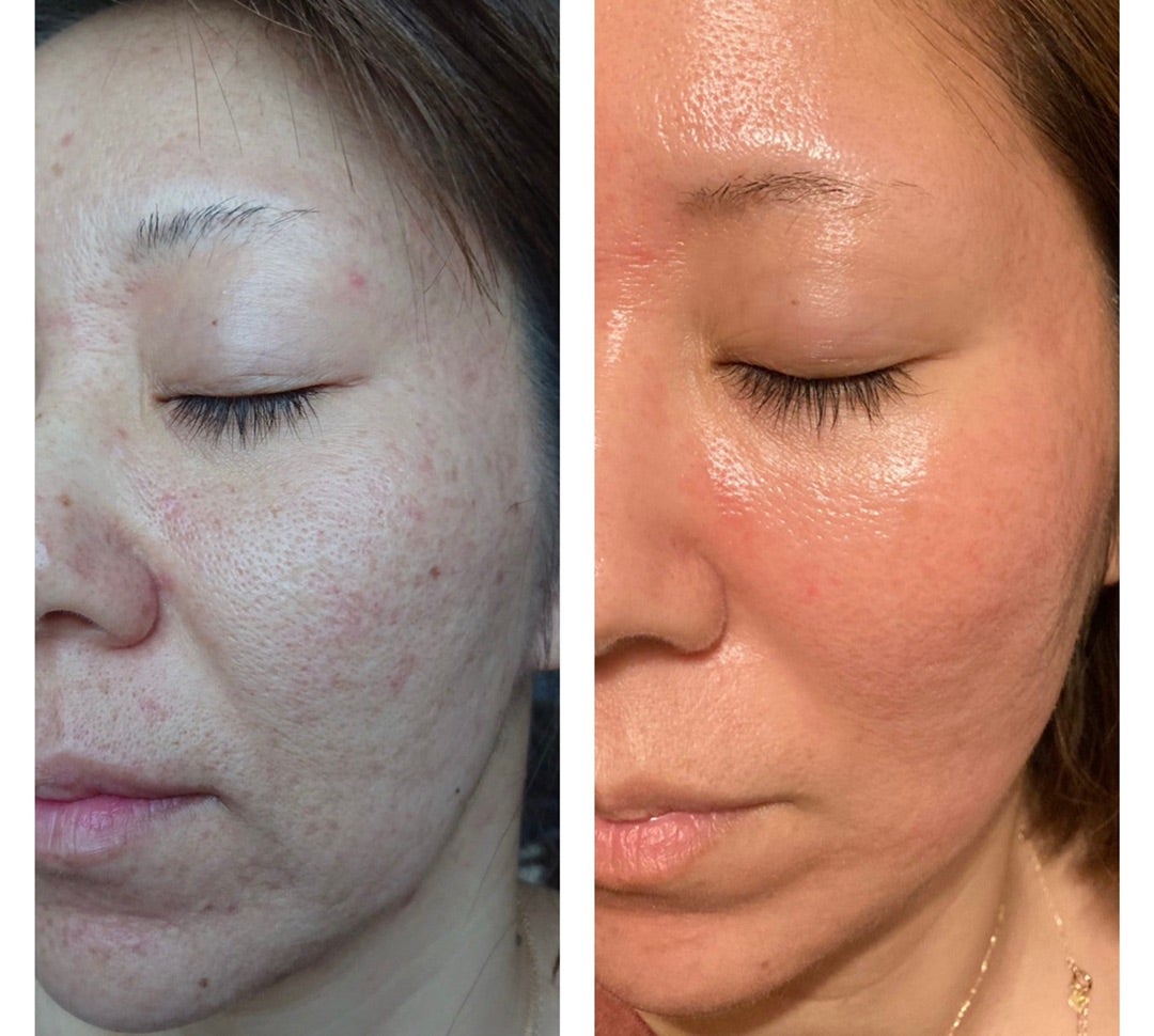 12月31日まで【大特価年末セール】剥離ありハーブピーリング20回分