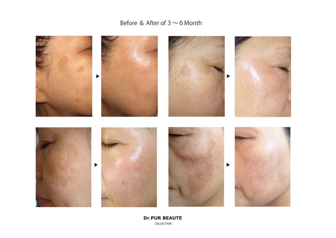 Dr.PURピュールボーテ【#6美白クリーム】美容皮膚科クリニック提携