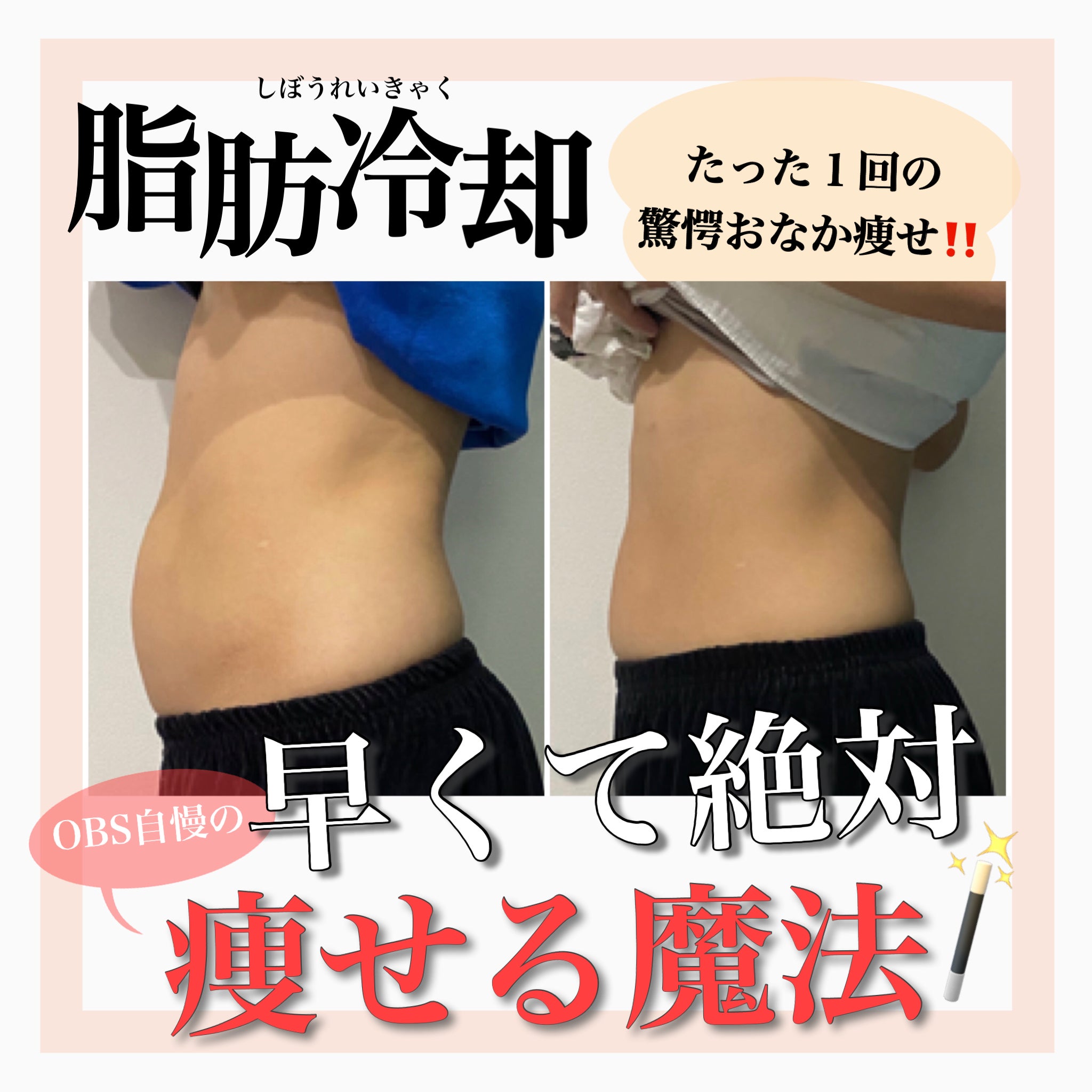 脂肪冷却ならOBS♪『ぽっこりお腹』 | 宮崎市島之内のエステサロンOBS