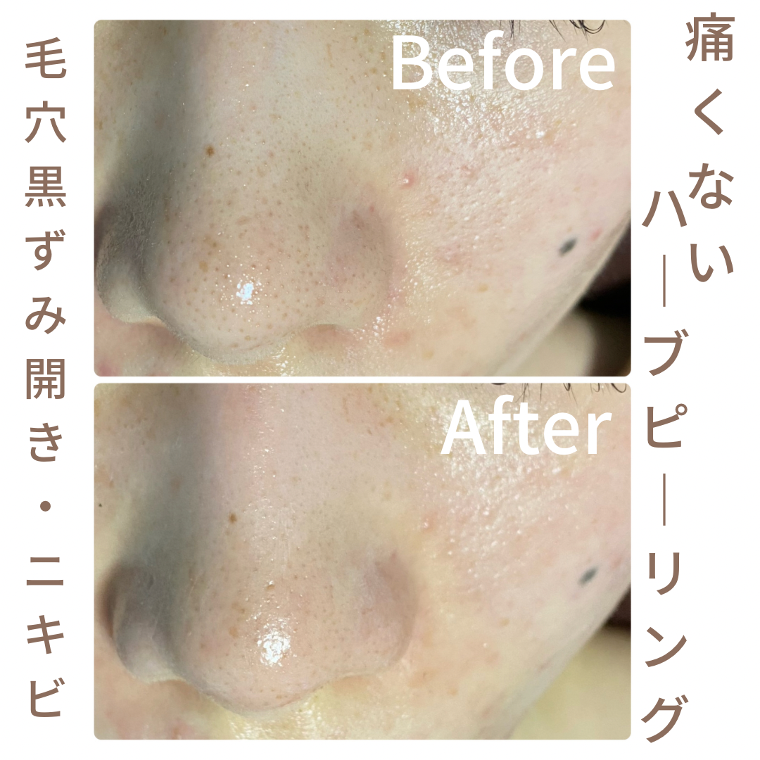 毛穴1回ビフォーアフター】酵素のハーブピーリング | Luana Aina 池袋