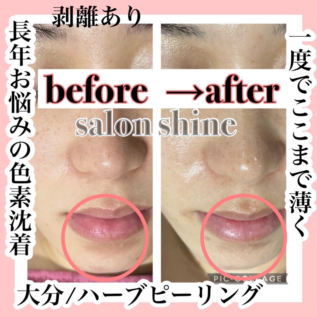 大分ハーブピーリング 剥離有☆色素沈着もお任せ下さい☆ ハーバル