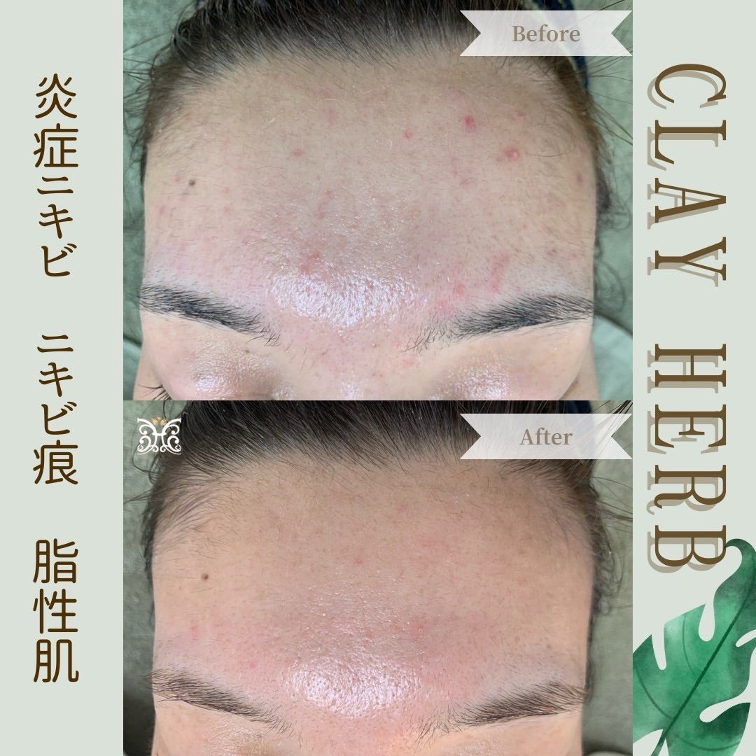 剥離なしハーブピーリングの6回～10回分の効果が!! | ハーブ