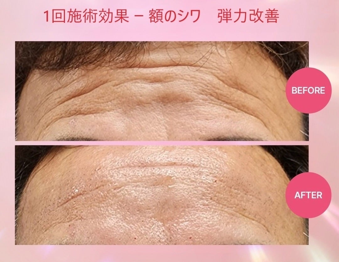世界初のプラズマ登場！！本気の肌質改善へ | 脱！老け顔✨Natural