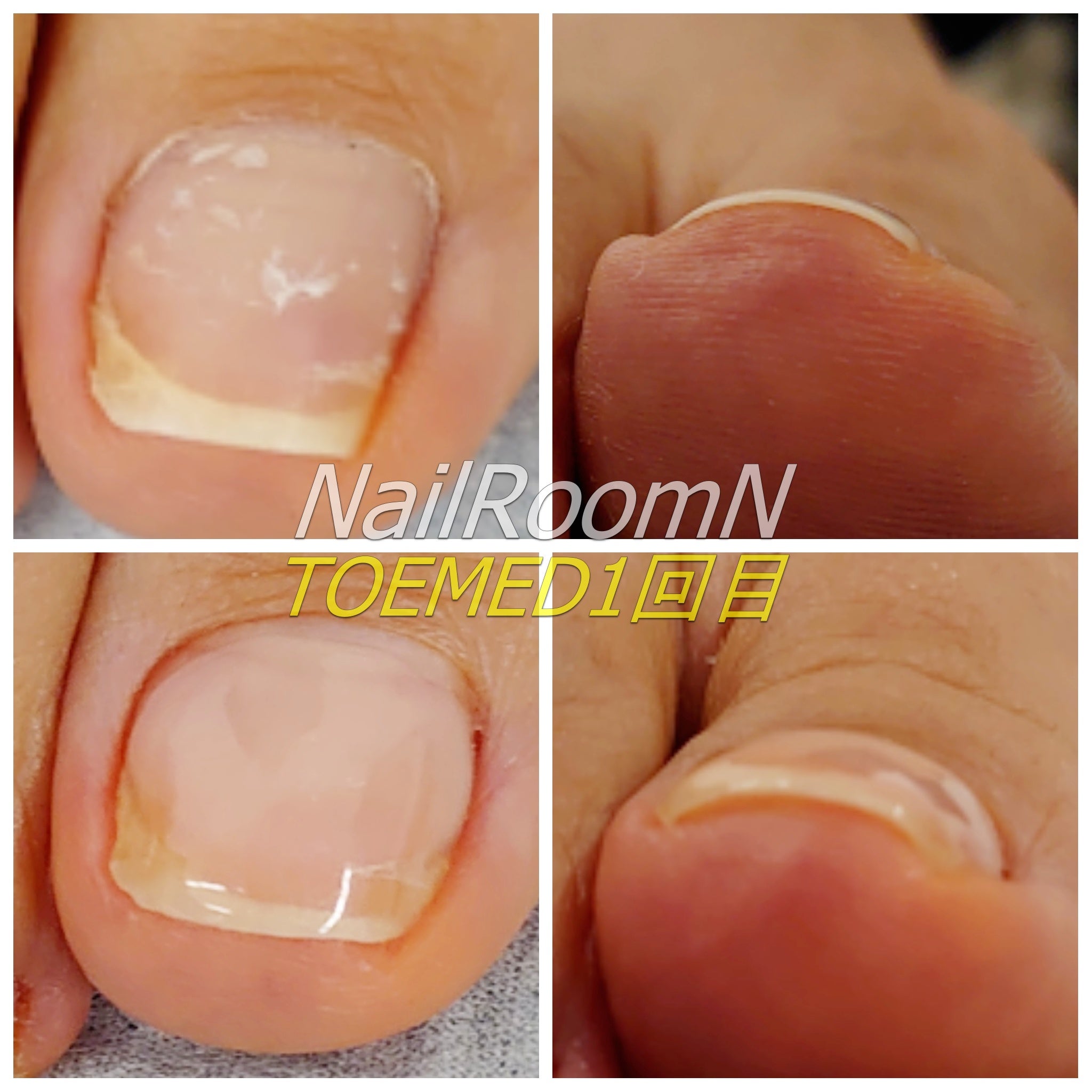 巻き爪ケアジェル TOEMEDレビュー | ぐっちのネイル部屋