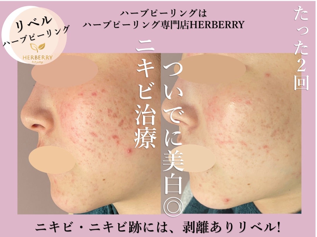 最強リベルハーブピーリング◇即効性◎美白効果も◎ | ハーブ