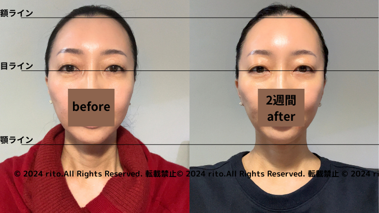 コアフィットフェイスプレイヤー2の効果をビフォアフ発表！旧製品と