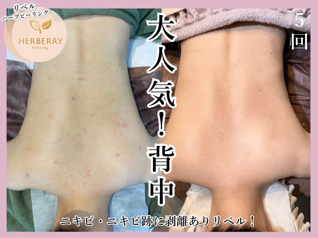 専用ハーブピーリング剥離無し 10回分（11月11日から2月20日の間発送