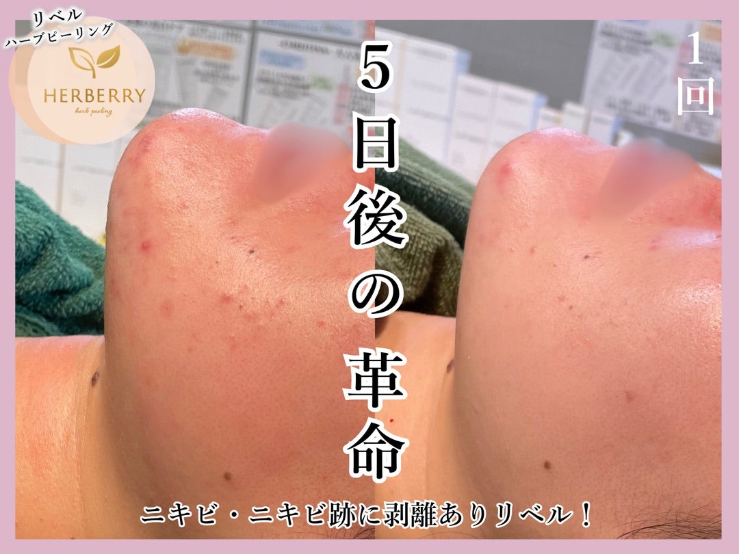 剥離ありハーブピーリング、翌日から化粧可能です◎ | ハーブ