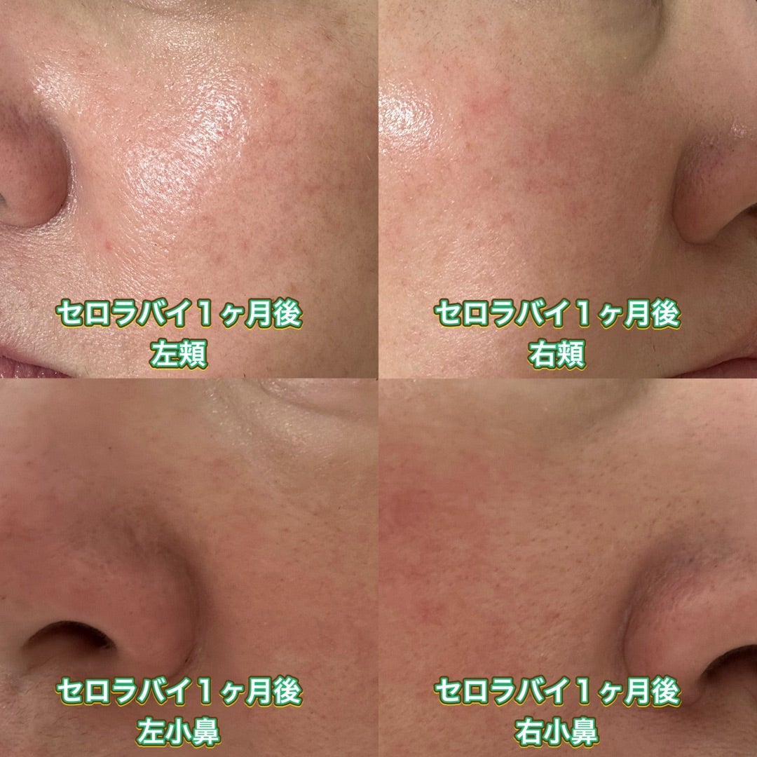 セロラバイ【ペンタショット】1ヶ月使い続けた結果