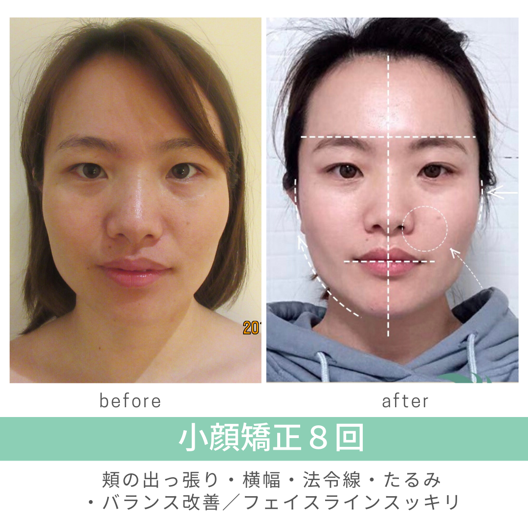 顔の左右非対称の原因とは？ | 本格小顔骨盤美容矯正サロン BITORIA 横浜店