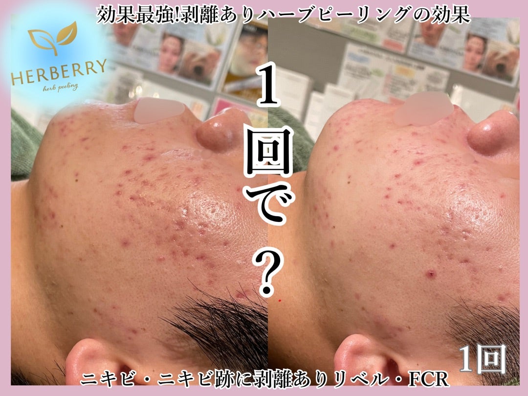 最速＆最強の肌治療→剥離ありハーブピーリング！ | ハーブピーリング