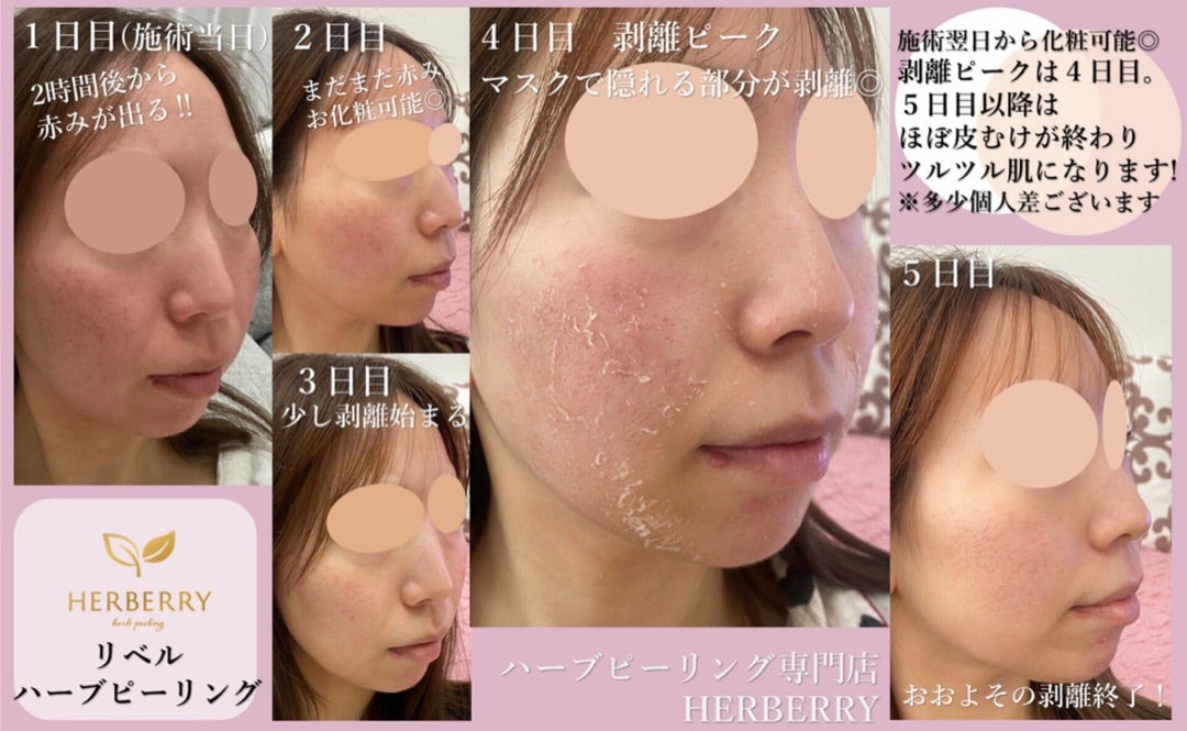 ハーブピーリング 剥離あり 20回分 ローション付き 【公式通販】