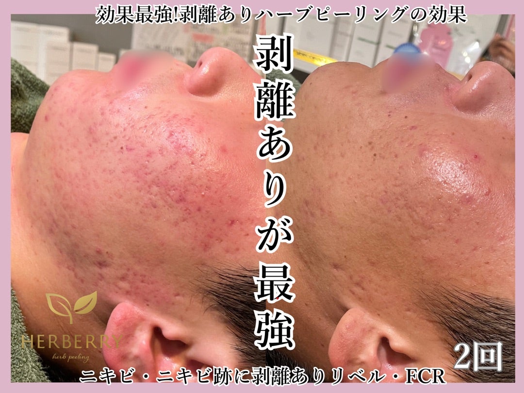 剥離ありハーブピーリング5日間のダウンタイムは一瞬! | ハーブ