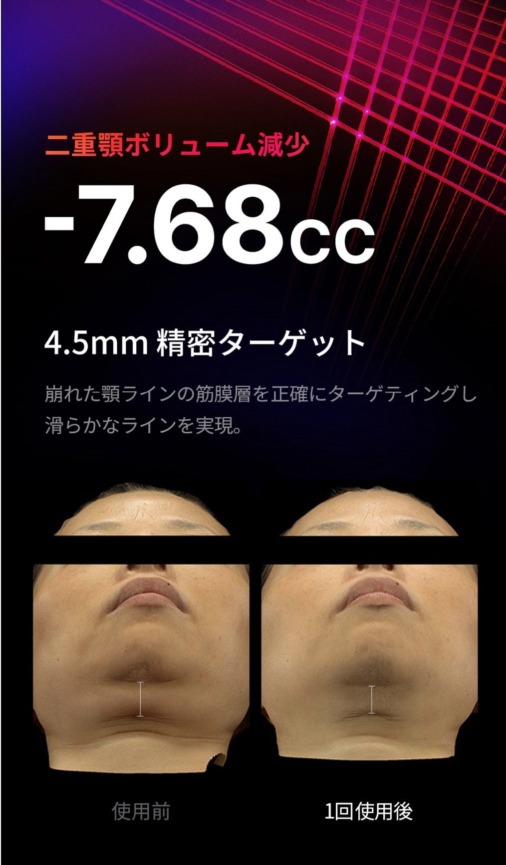 44%オフ】最新ハイフ美顔器の情報解禁！明日決戦です！ | エマの日記