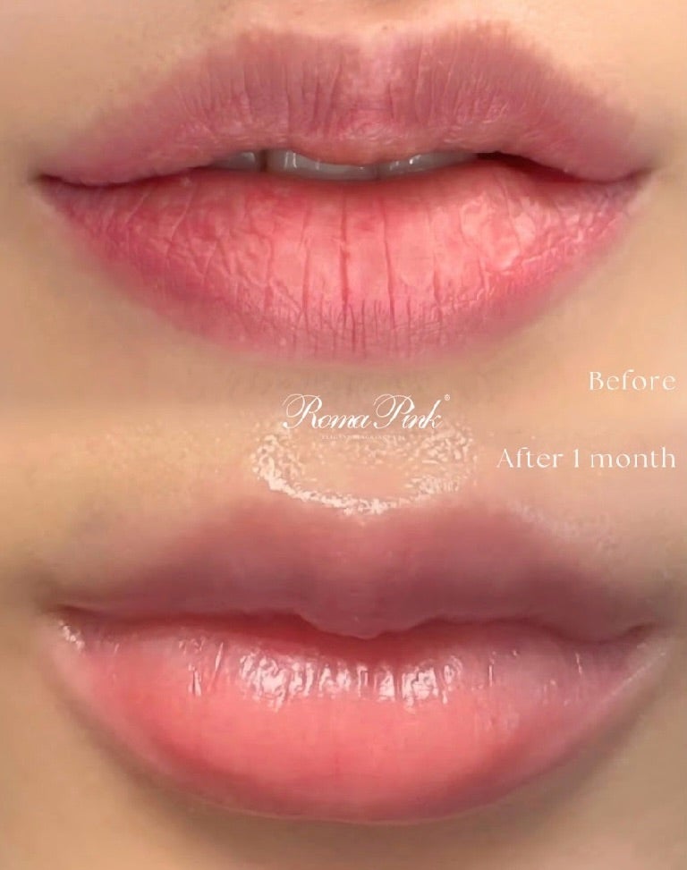 唇やボディの黒ずみをヴァージンピンクに戻す施術✨ | ローマピンク