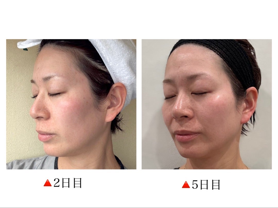 ピーリングチャレンジ！ボタニカルピールlevel7使用レポ | 大阪・30代