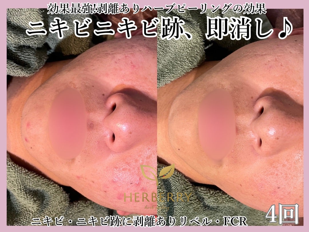 剥離ありハーブピーリングお顔のダウンタイムは5日程! | ハーブ