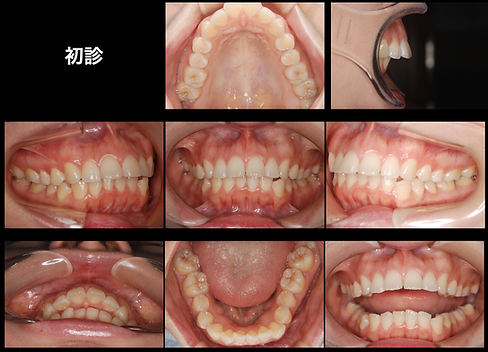 矯正治療 顎が後ろに下がっている症例（非抜歯矯正） | つかだ歯科医院