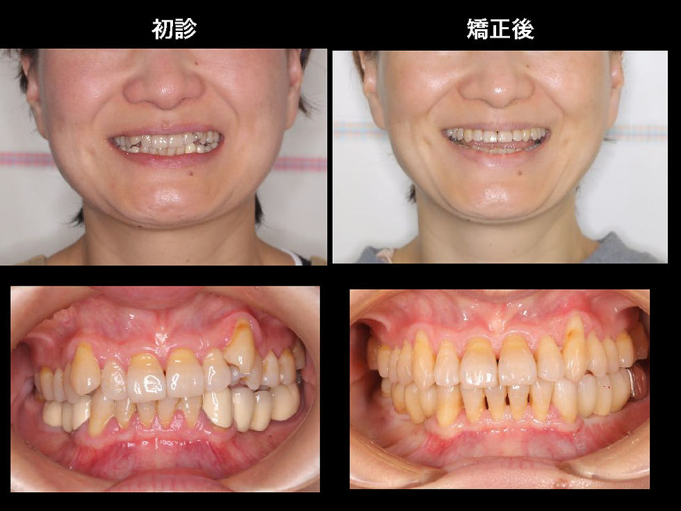 うまく噛めなくて食事が取りづらい。物を飲み込みづらい。歯列矯正治療