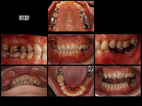 顔が右に曲がっている。咬合再構成 矯正治療 歯周病治療 インプラント