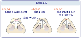 鼻の形成術｜甲府昭和形成外科クリニック【公式】(ヒアルロン酸 脂肪
