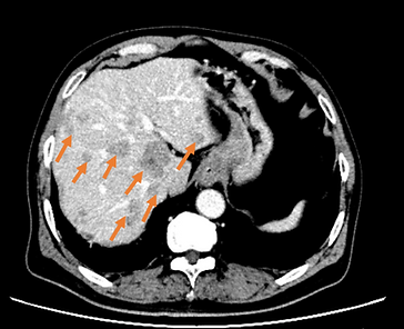 胃がんにおける免疫療法（免疫細胞治療）の症例｜銀座鳳凰クリニック｜東京
