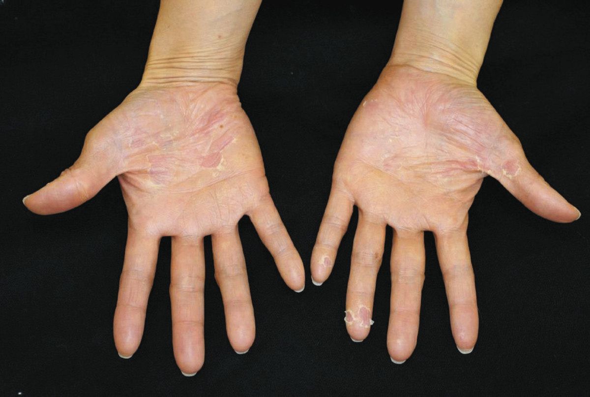 手や足に水膨れなど「掌蹠膿疱症」 皮膚科と歯科 連携探る 口内の治療