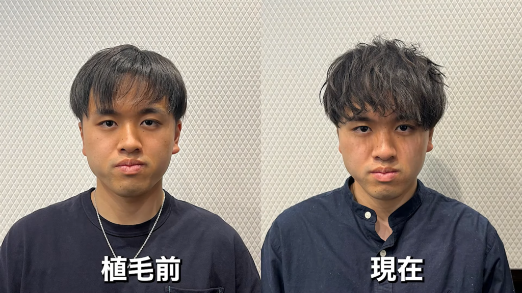 祝1年経過】スケスケ前髪だった20代男性が自毛植毛で大変身！ | 薄毛