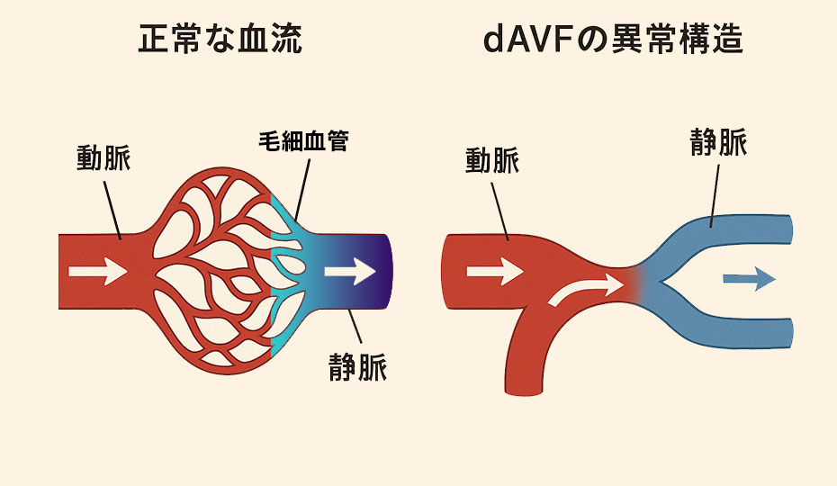 硬膜動静脈瘻が引き起こす脳出血の原因とリスクを知る - 脳梗塞・脊髄